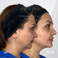 Ультраформер 2