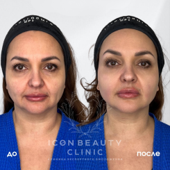 Ультраформер